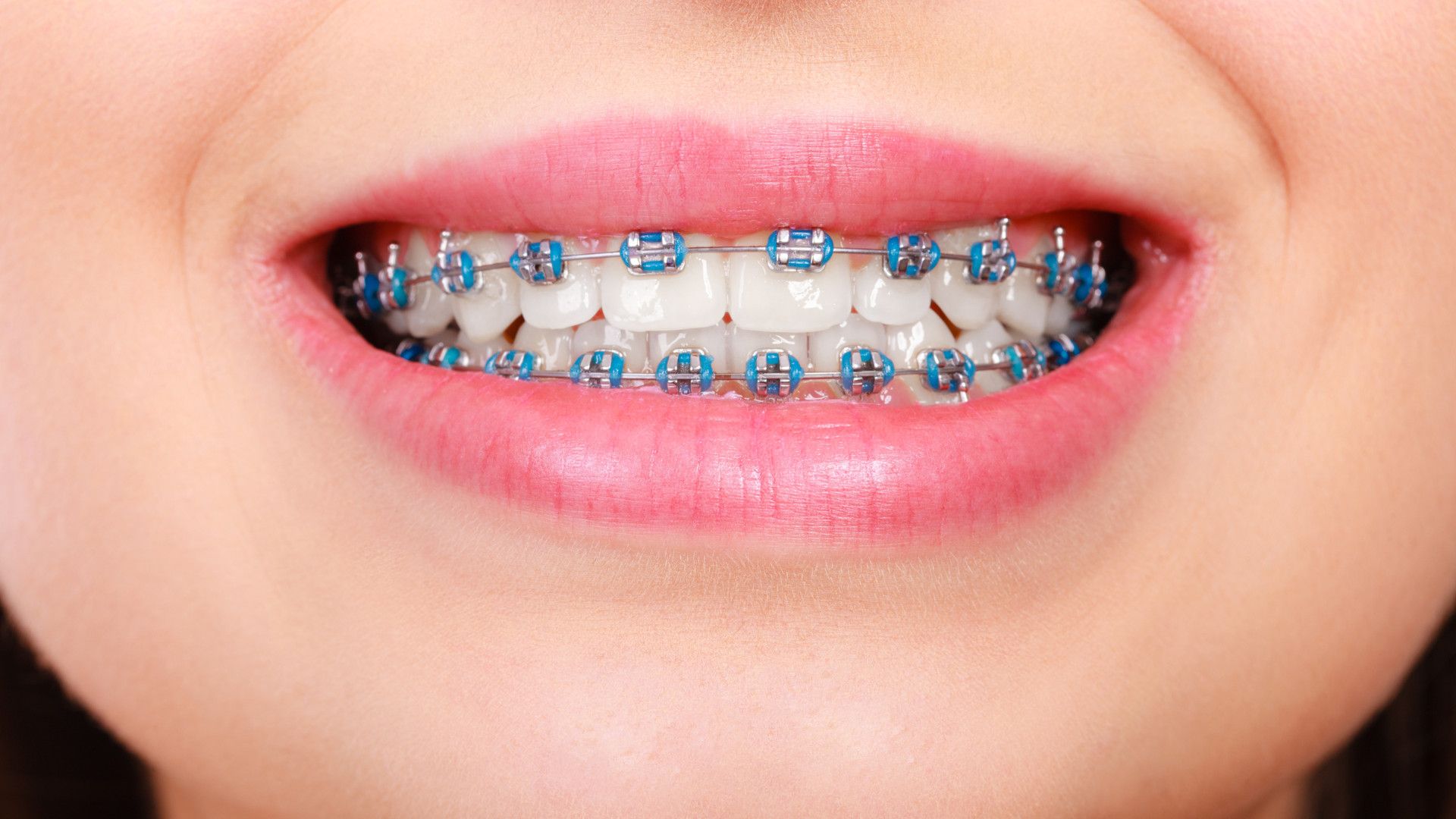 lady smiling with braces on